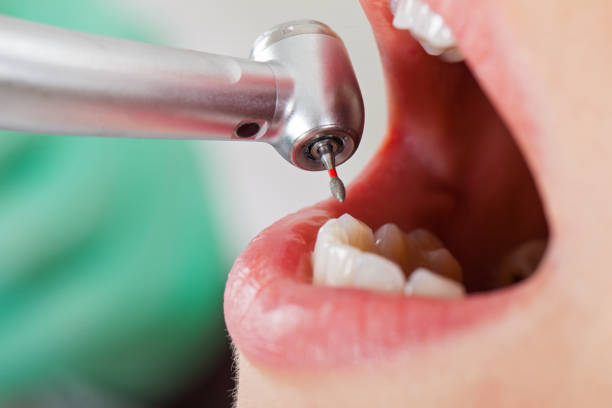 Best Emergency Tooth Extraction  in Gholson, TX